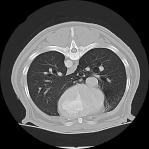 Normal examination of the lungs with thoracic CT.