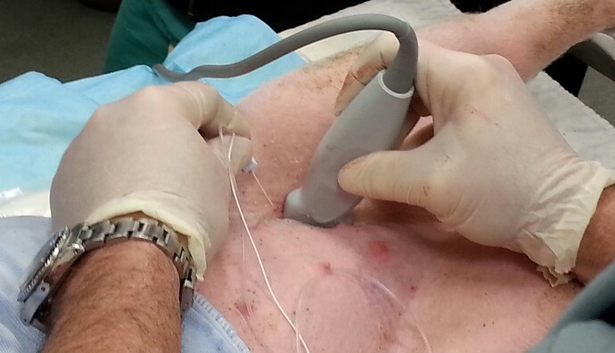 Ultrasound-Guided Peripheral Nerve Stimulation